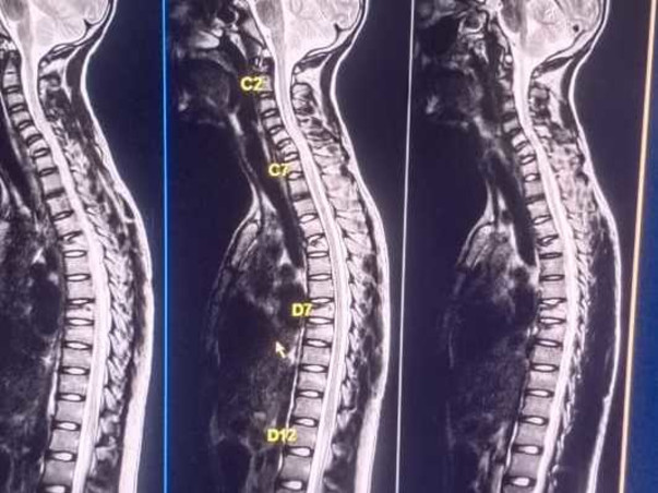 Help my friend Dogga ramasatyam fight Backbone cracks