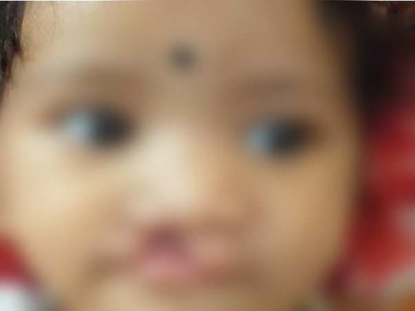 My Daughter Is Struggling With Cleft Lip, Help Her