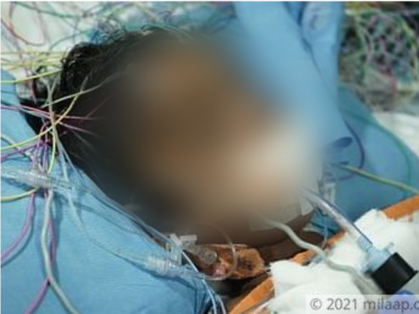 Support Likitha Recover From Brain Infection