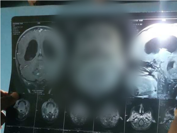 Support Pavishna Recover From Brain Tumor