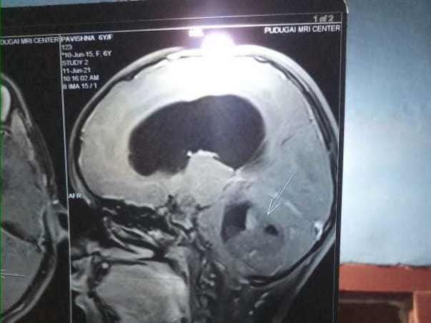 Support Pavishna Recover From Brain Tumor