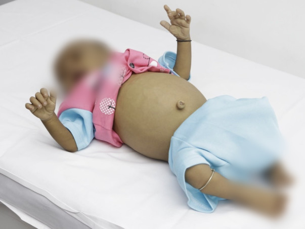 Help my son fight Biliary cirrhosis