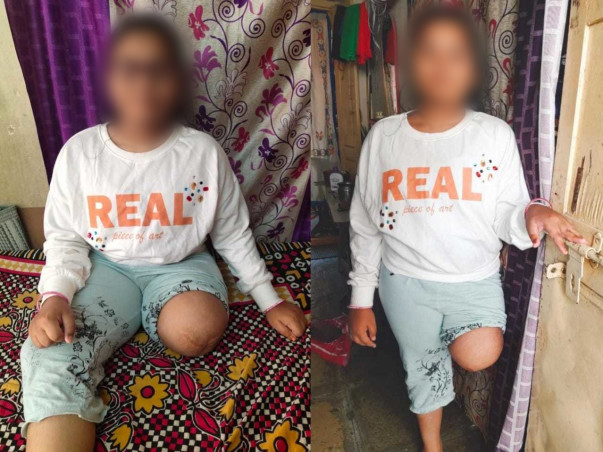 17 years old Akshitha needs your help fight For German prosthetic Leg transferomal