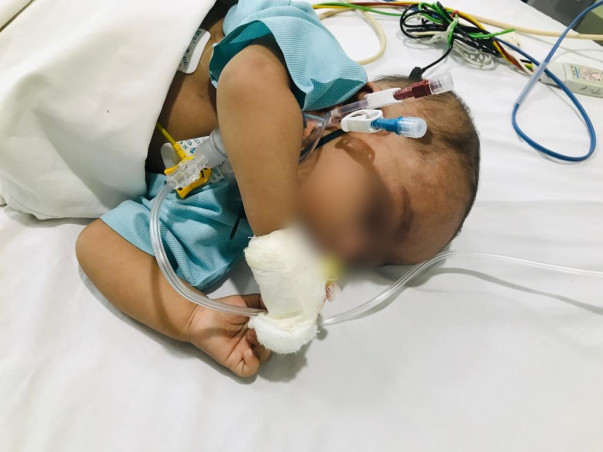 Baby Ananya needs your help to fight JMML with nf1 blood cancer