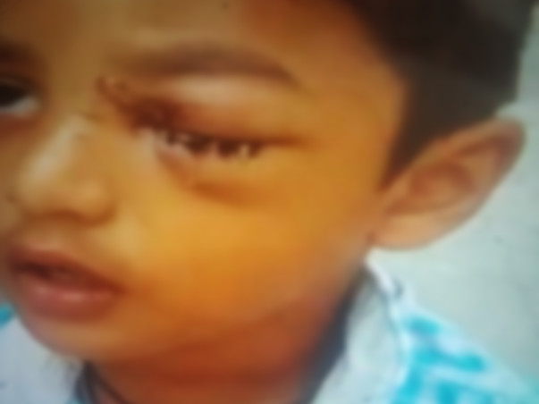 Support My Son To Undergo Eye Surgery