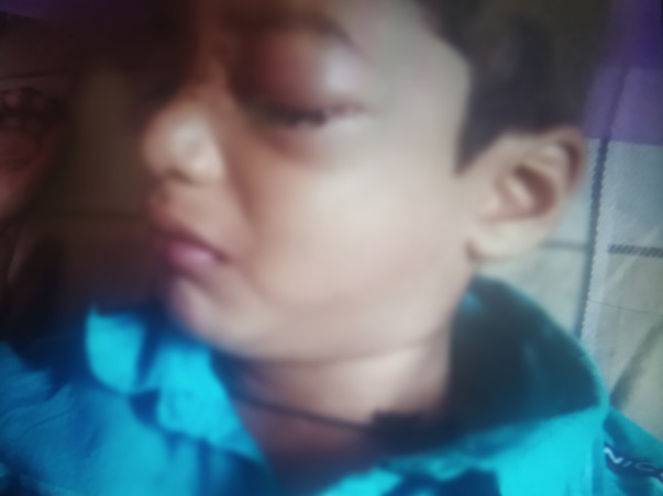 Support My Son To Undergo Eye Surgery