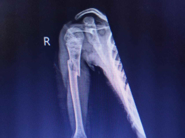 Support Sanjay Recover From Osteogenesis Imperfecta