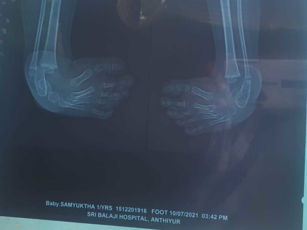 Support Samuktha To Undergo Leg Surgery