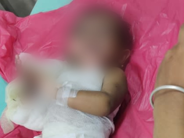Support Dhanika Recover From Accidental Fire Burn