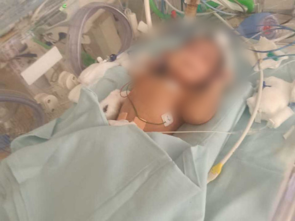 Support  This 9 Days Baby To Fight With Meconium Aspiration Syndrome