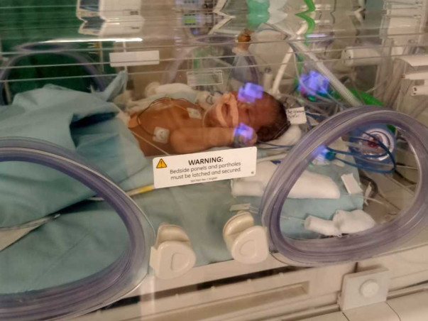 Support  This 9 Days Baby To Fight With Meconium Aspiration Syndrome