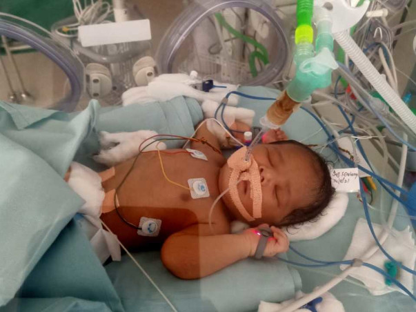 Support  This 9 Days Baby To Fight With Meconium Aspiration Syndrome