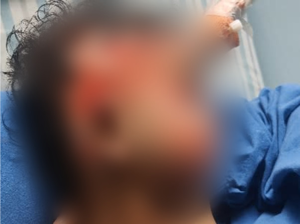 Support Dhanika Recover From Accidental Fire Burn