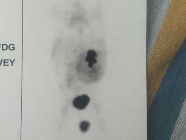 Support Ranesh Krishna Recover From Kidney Tumour