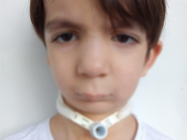 Help avyaan to remove his tracheostomy tube