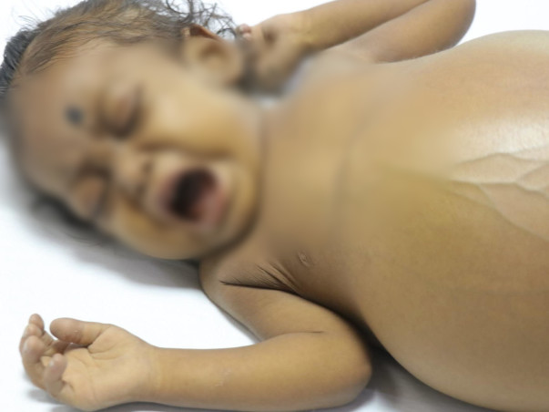 1-Year-Old With Watermelon-Sized Stomach Needs Urgent Liver Transplant