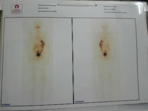 Help My Nephew To Recover From Thyroid Cancer