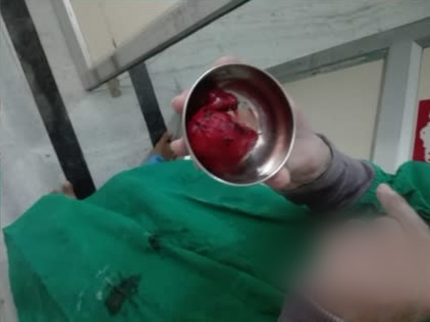 Help My Nephew To Recover From Thyroid Cancer