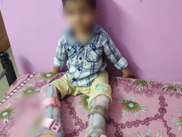 2 Years Old Aahil Iyad Needs Your Help To Recover From Bilateral Congenital Pseudarthrosis Of Tibia