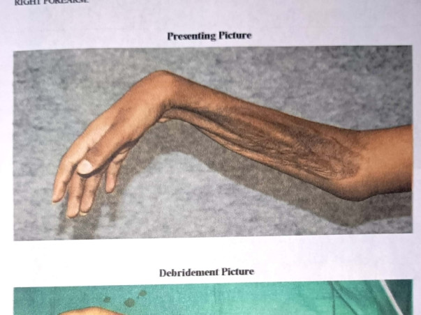 Help Surya a 16 Year Old Restore His Hands & His Life
