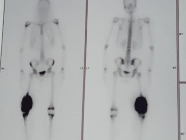 Help Sahitha Fight Bone Cancer