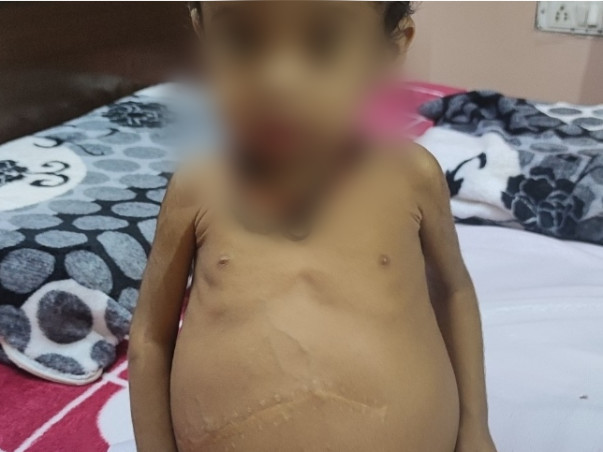 18 months old Anayka needs your help to undergo Liver Transplant