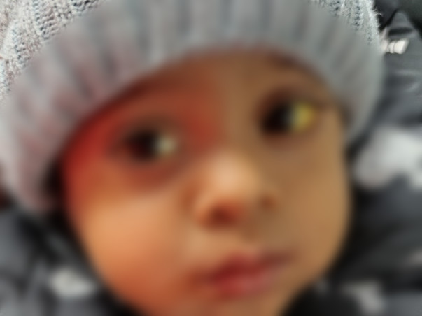 18 months old Anayka needs your help to undergo Liver Transplant