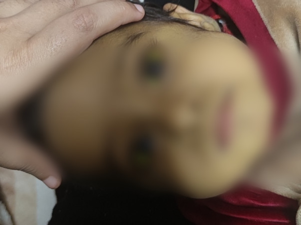 18 months old Anayka needs your help to undergo Liver Transplant