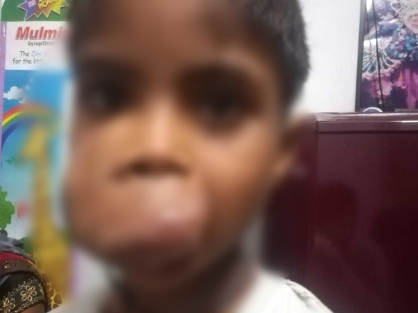 7-Year-Old With Rapidly Growing Facial Tumour Needs Urgent Surgery
