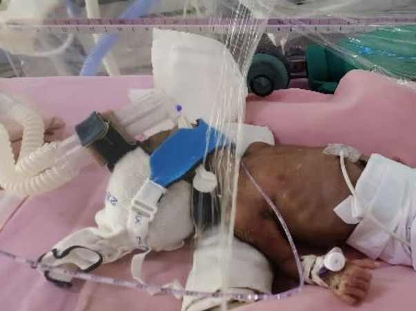 Support Baby Of Aswini  To Recover From Preterm Birth