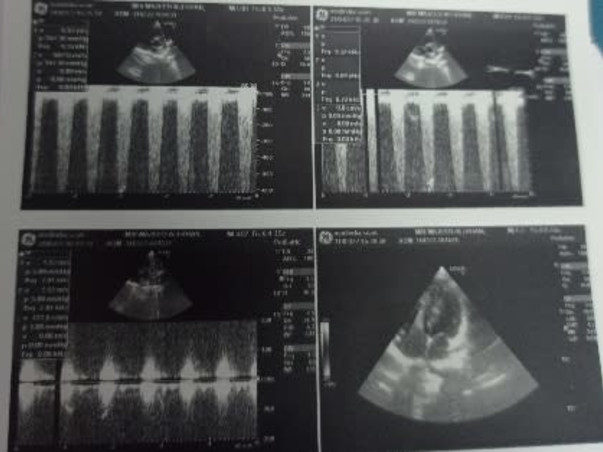 Support Mir Majid Ali Khan Recover From Cardiac Valve