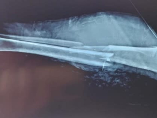 Help Naveen To Walk Again As He Met With Severe Leg Accident