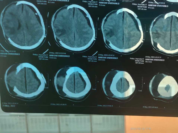 Support Harshavardhan Damineni Recover From Accidental Multiple Injury