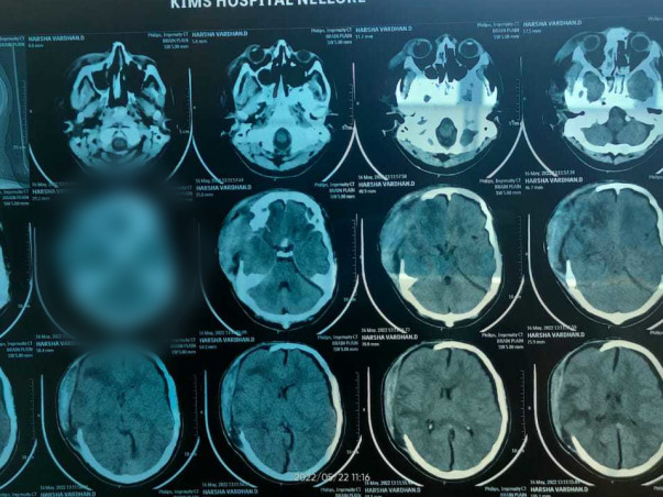 Support Harshavardhan Damineni Recover From Accidental Multiple Injury