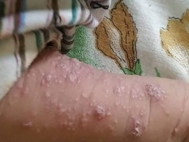 Support Shiwansh Dahal Fight from Juvenile Myelomonocytoc Leukemia