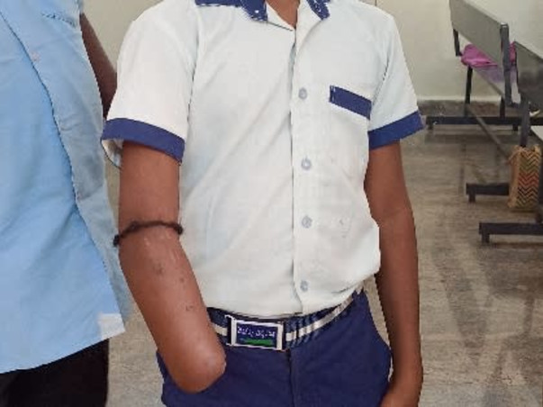 Support Pawan Kumar To Fix The Artificial Hand