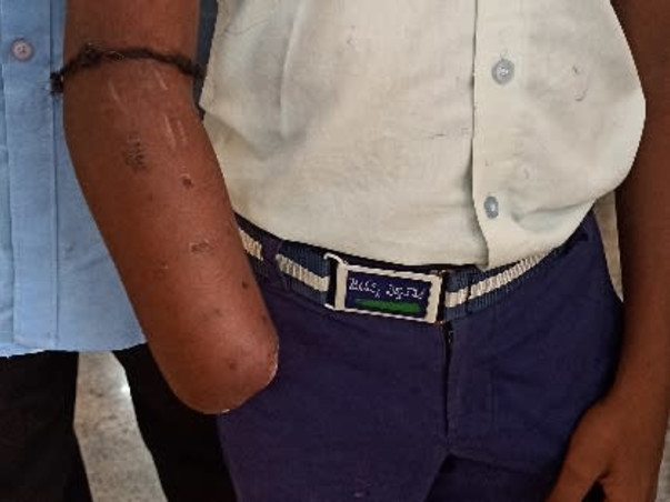 Support Pawan Kumar To Fix The Artificial Hand