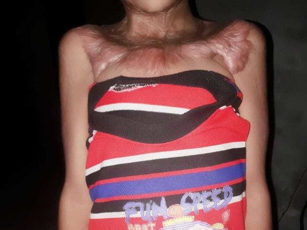 7 Years Old Abhiya Needs Your Help Fight Burn Injuries