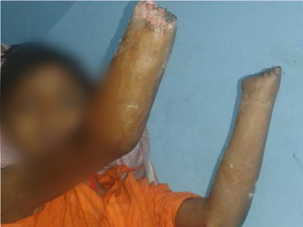 14 Years Old Pintu Paswan Needs Your Help To Recover From Accident