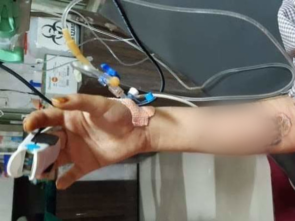 13 Years Old Rida Needs Your Help To Recover From Severe Electric Burn