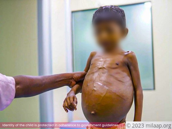 This Father Is Struggling To Save His Child From Severe Liver Damage