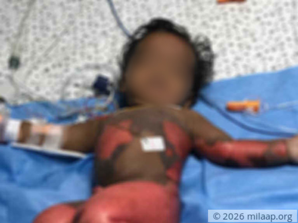 65% Of This Baby’s Body Is Burnt And He’s Struggling To Live