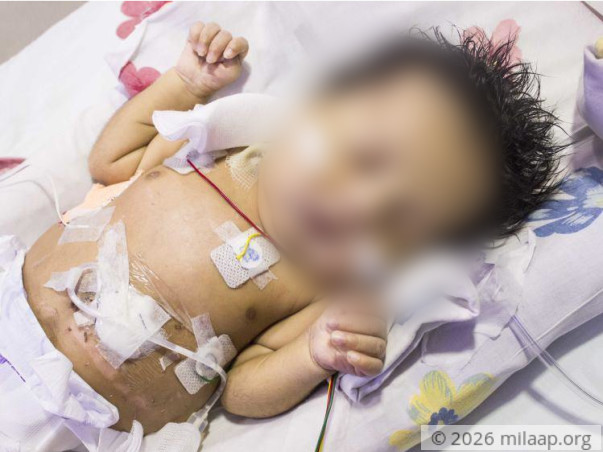 This Baby Boy Born Without Food Pipe Will Die Without Treatment