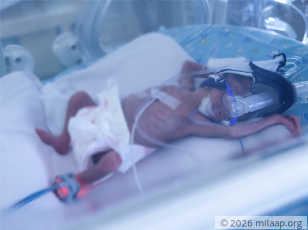 Only 600 Grams At Birth, These Twins Need Help To Survive