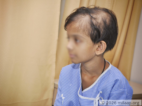 5-Year-Old Hates Looking At Herself As Cancer Changed Her Drastically