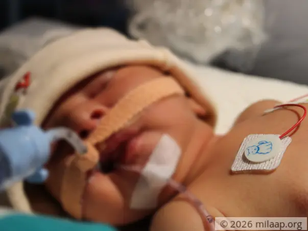 Baby of Rayeesa needs your help to survive