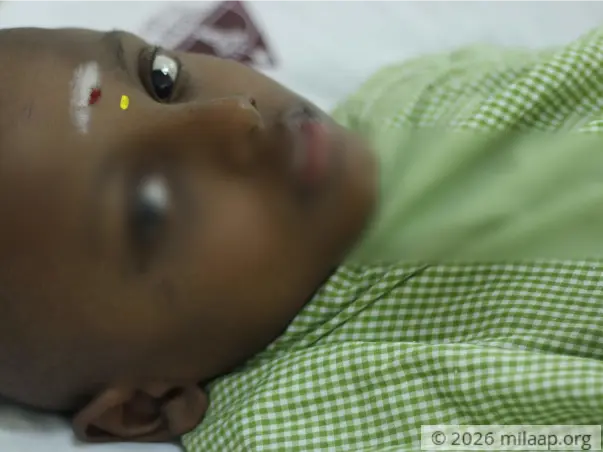 A Small Bruise On His Eye Turned Out To Be Deadly Cancer