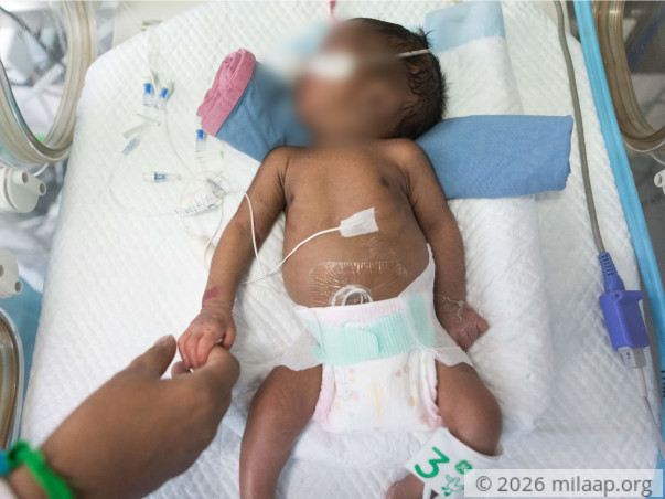 He Lost His Twin Sister, Now This Newborn Fights To Survive