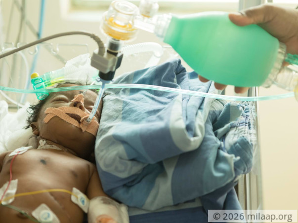 This Baby Was Born With His Stomach Where His Heart Is Supposed To Be