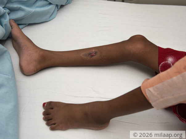 help-yashoda-recover